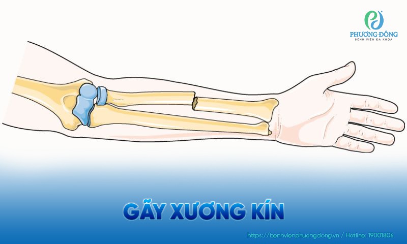 Gãy xương kín: Nguyên nhân, triệu chứng và phương pháp điều trị