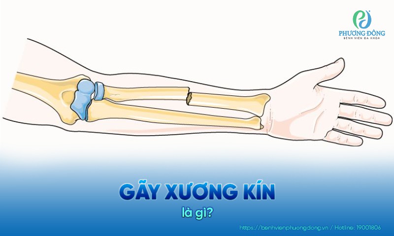 Hình ảnh gãy xương kín