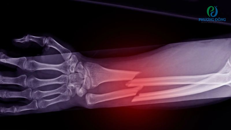 Những vị trí thường xảy ra gãy xương không đâm xuyên qua da
