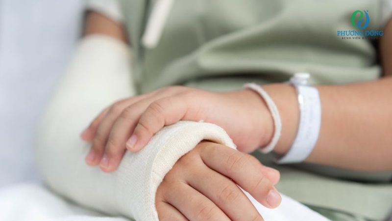Bó bột là phương pháp chính điều trị gãy xương