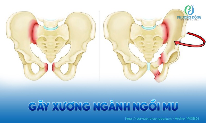 Gãy xương ngành ngồi mu bao lâu thì lành? Cách phục hồi hiệu quả