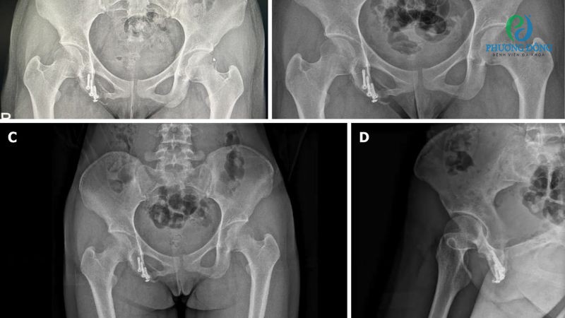 Cần 4 - 8 tuần để xương gãy liền lại