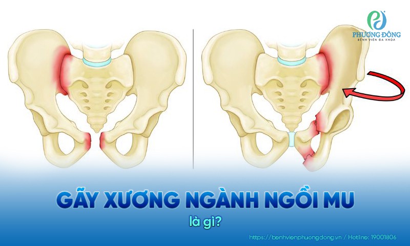 Gãy xương ngành ngồi mu nhẹ có thể tự hồi phục kết hợp nghỉ ngơi
