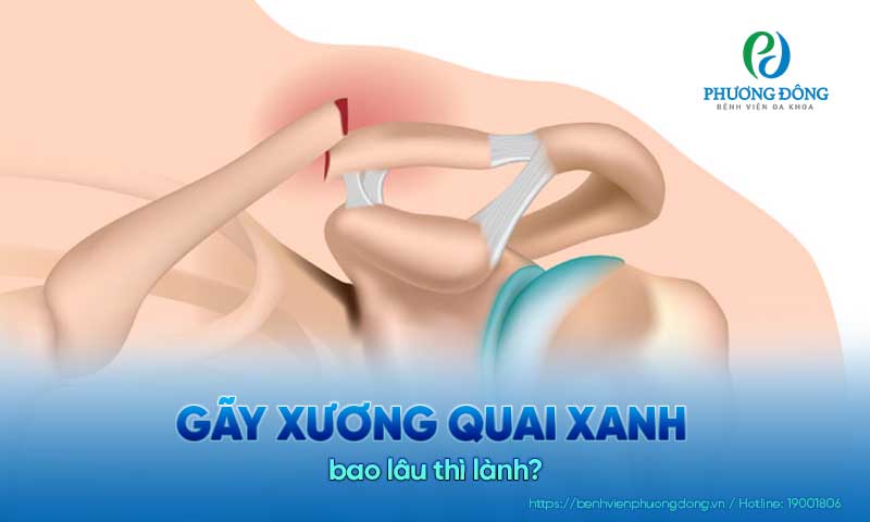 Gãy xương quai xanh bao lâu thì lành?