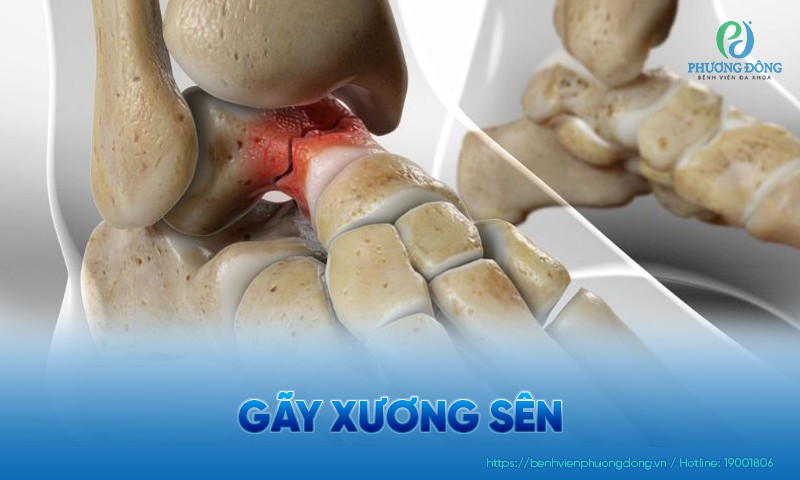 Gãy xương sên: Nguyên nhân, triệu chứng và điều trị