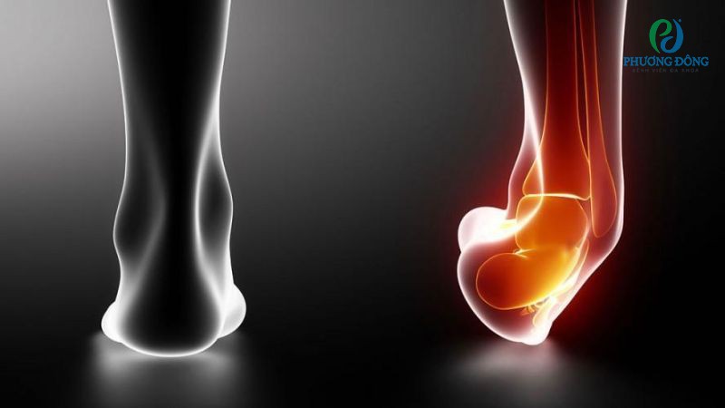 Nguyên nhân khiến xương cổ chân bị gãy