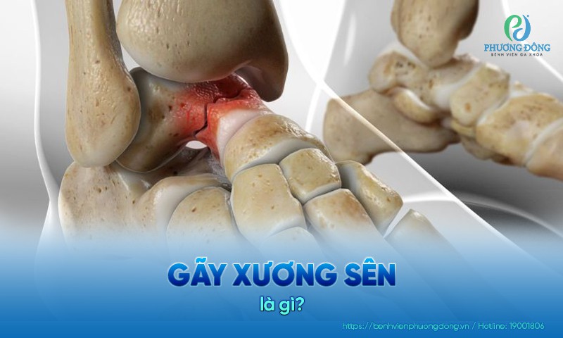 Phân loại cấp độ gãy xương sên