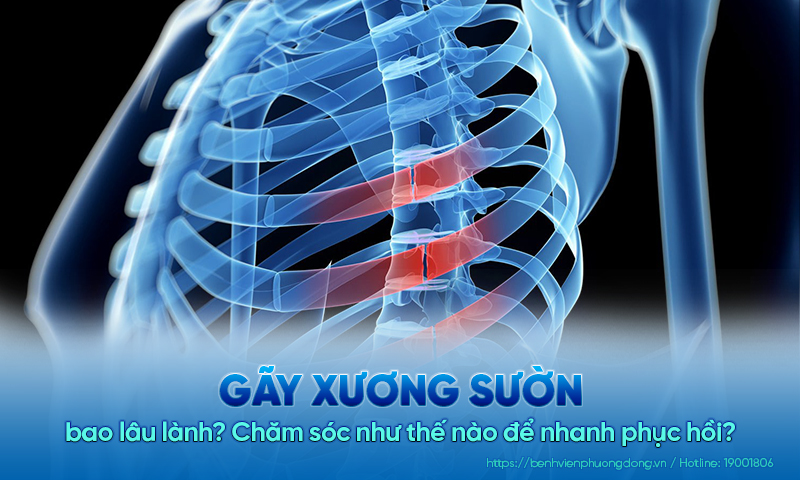 Minh hoạ hình ảnh xương sườn bị gãy