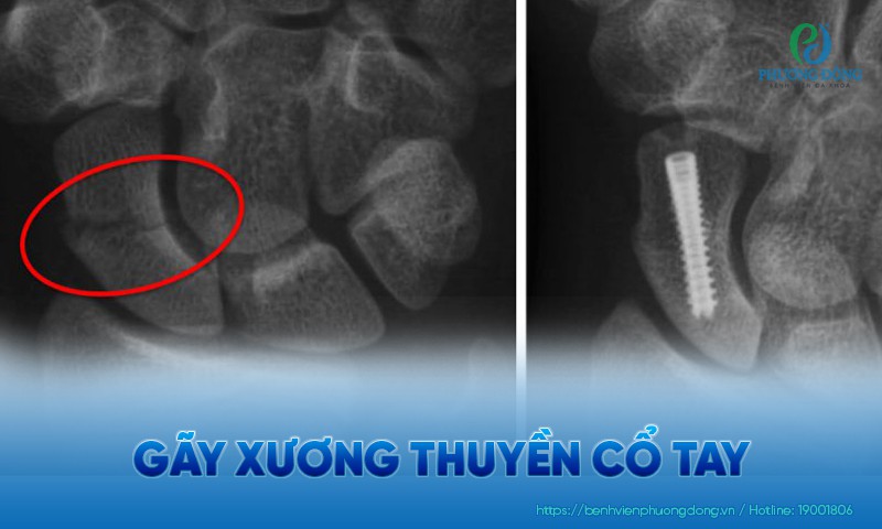 Gãy xương thuyền cổ tay: Nguyên nhân, triệu chứng và hướng điều trị