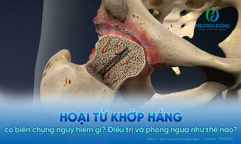Hoại tử khớp háng có biến chứng nguy hiểm gì? Điều trị và phòng ngừa như thế nào?