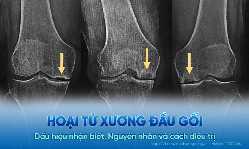 Hoại tử xương đầu gối: Dấu hiệu nhận biết, Nguyên nhân và cách điều trị