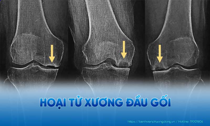 Hoại tử đầu gối dưới ảnh chụp X Quang