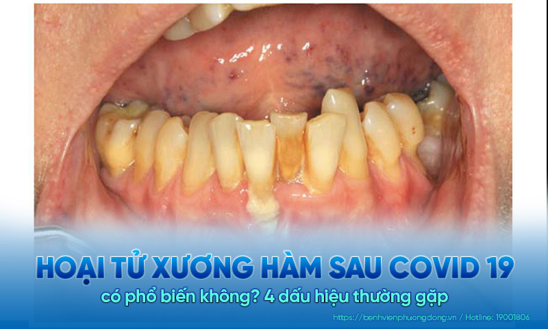 Hoại tử xương hàm sau COVID 19 có phổ biến không? 4 dấu hiệu thường gặp