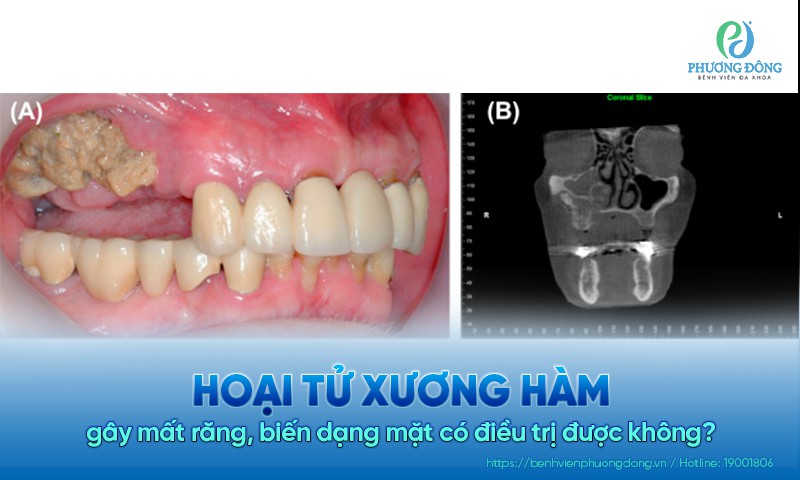 Hoại tử xương hàm gây mất răng, biến dạng mặt có điều trị được không?