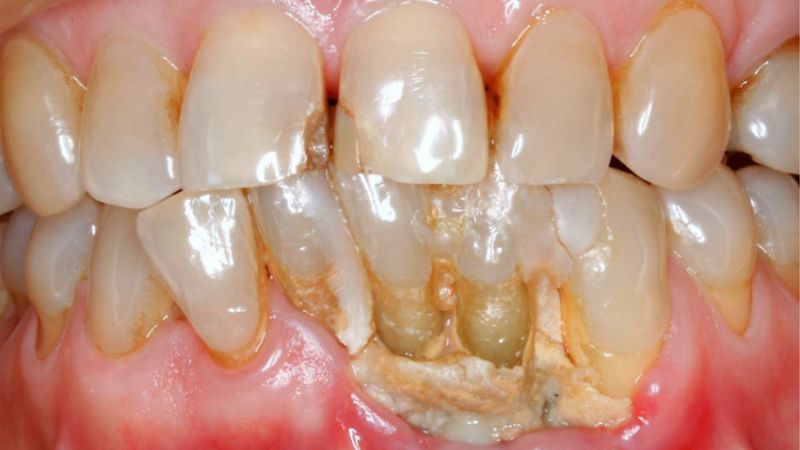 Hoại tử khiến xương hàm bị lộ ra ngoài, nướu bị viêm và sưng to