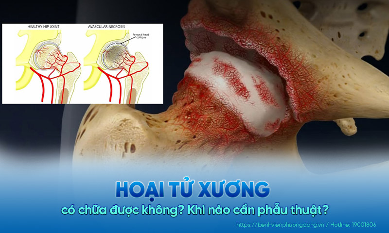 Hoại tử xương có chữa được không? Khi nào cần phẫu thuật?