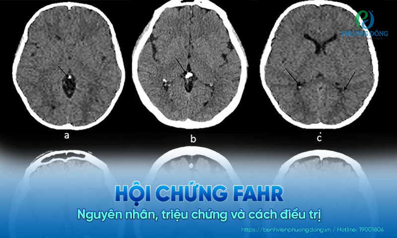 Hội chứng Fahr là gì? Nguyên nhân, triệu chứng và cách điều trị
