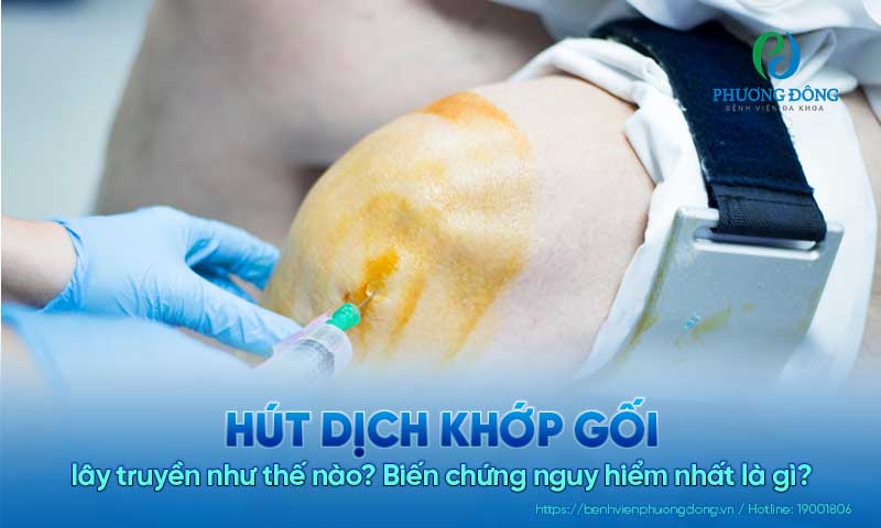 Hút dịch khớp gối có đắt không? Có an toàn không? Khi nào cần thực hiện?