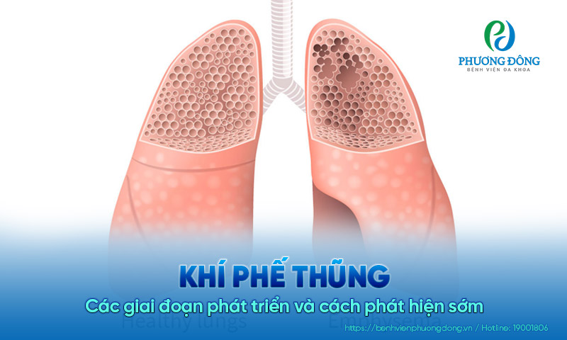 Khí phế thũng: Các giai đoạn phát triển và cách phát hiện sớm