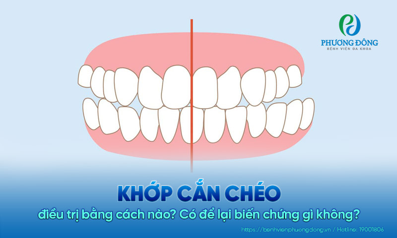 Khớp cắn chéo điều trị bằng cách nào? Có để lại biến chứng gì không?