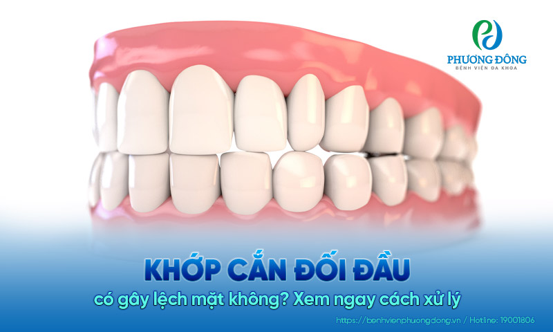 Khớp cắn đối đầu có gây lệch mặt không? Xem ngay cách xử lý