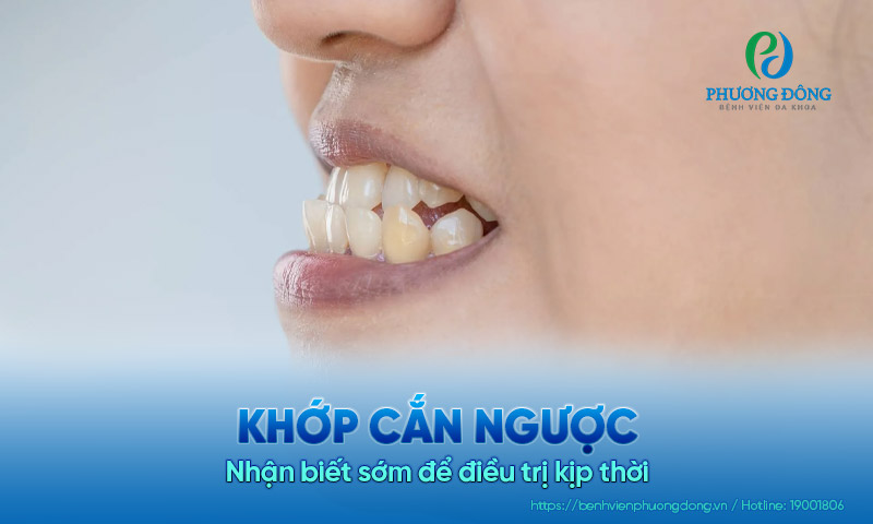 Khớp cắn ngược ở trẻ nhỏ: Nhận biết sớm để điều trị kịp thời