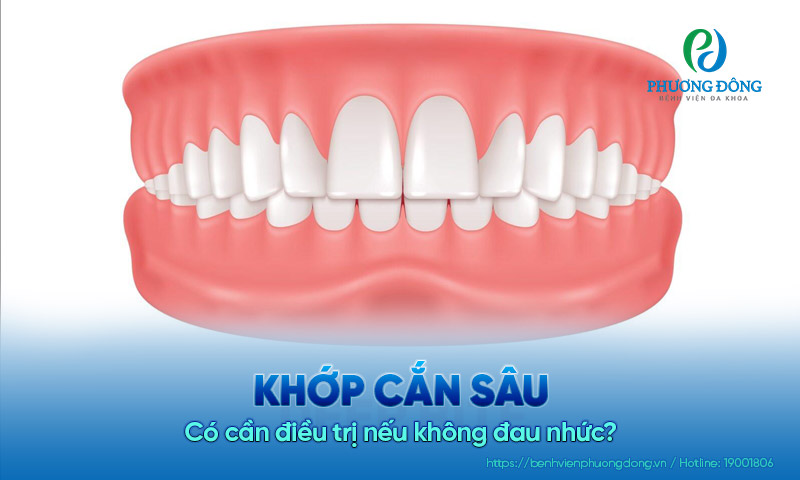 Khớp cắn sâu là gì? Có cần điều trị nếu không đau nhức?