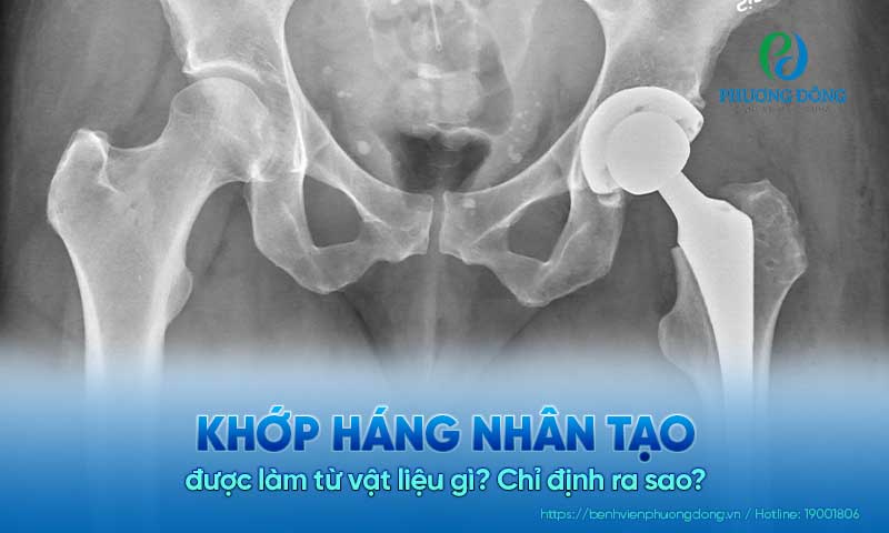 Khớp háng nhân tạo được làm từ vật liệu gì? Chỉ định ra sao?