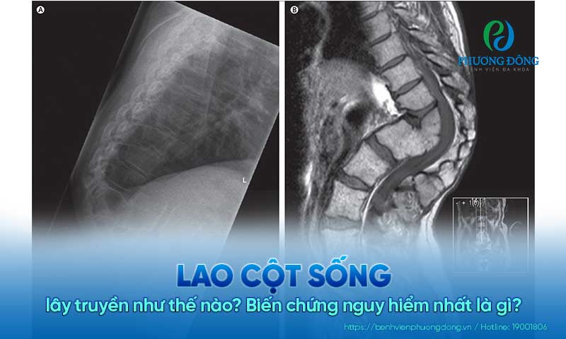 Lao cột sống lây truyền như thế nào? Biến chứng nguy hiểm nhất là gì?