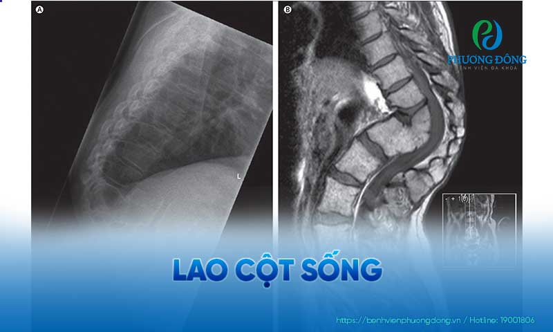 Hình ảnh cột sống của bệnh nhân dưới hình chụp X Quang và CT