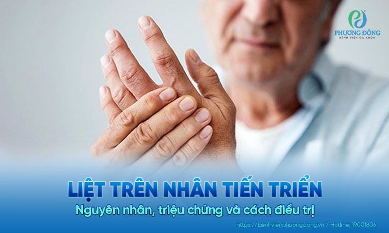 Liệt trên nhân tiến triển: Nguyên nhân, triệu chứng và cách điều trị