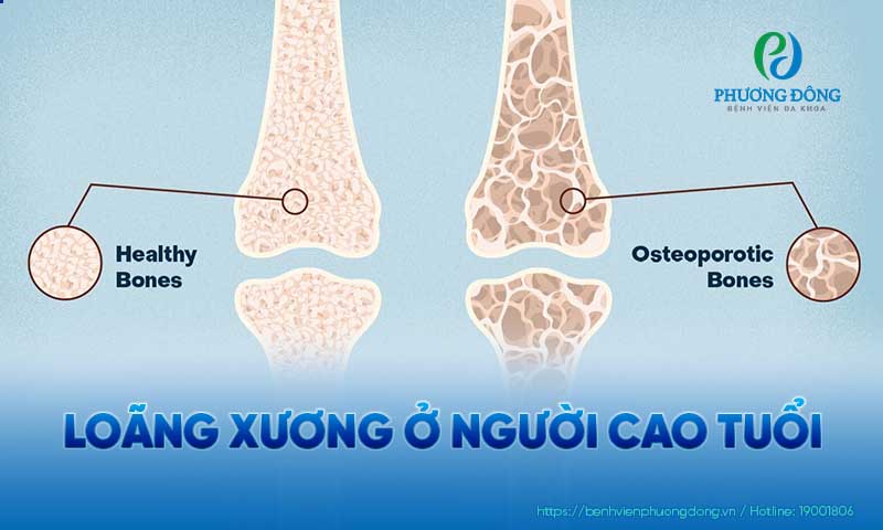 Minh hoạ xương bình thường và loãng xương
