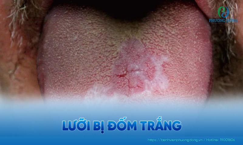 Lưỡi bị đốm trắng: Nguyên nhân, triệu chứng và hướng điều trị