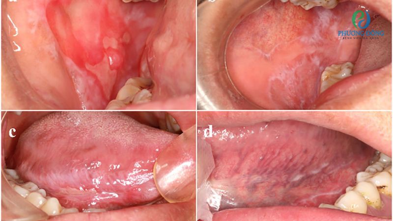 Đốm trắng ở lưỡi cảnh báo bệnh lichen phẳng