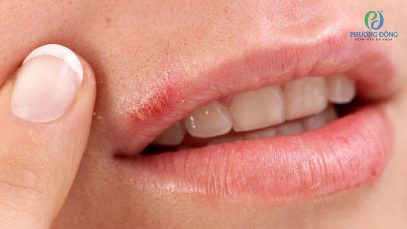 Nhiễm virus HSV-1 là tác nhân khiến lưỡi nổi đốm trắng