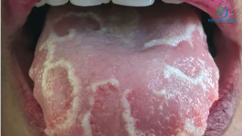 Tình trạng đốm trắng ở lưỡi cần nhanh chóng thăm khám bác sĩ
