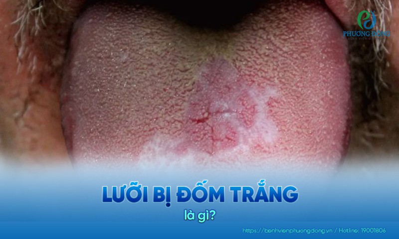 Chấn thương khiến lưỡi bị đốm trắng