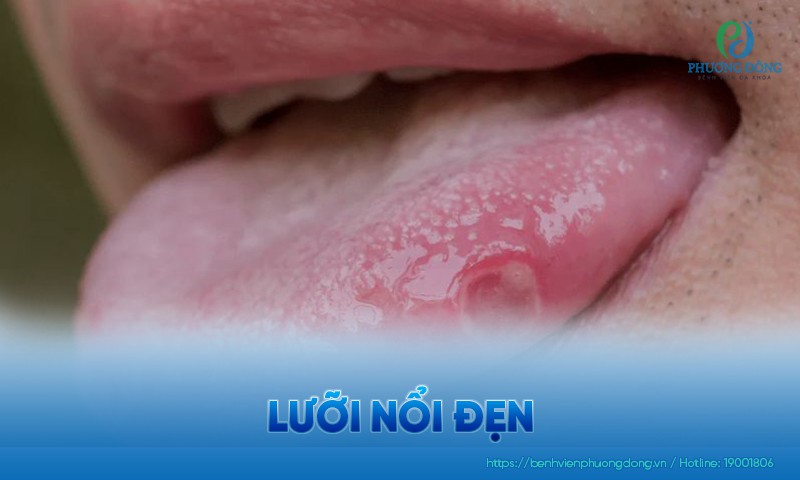 Lưỡi nổi đẹn: Triệu chứng, nguyên nhân và cách điều trị