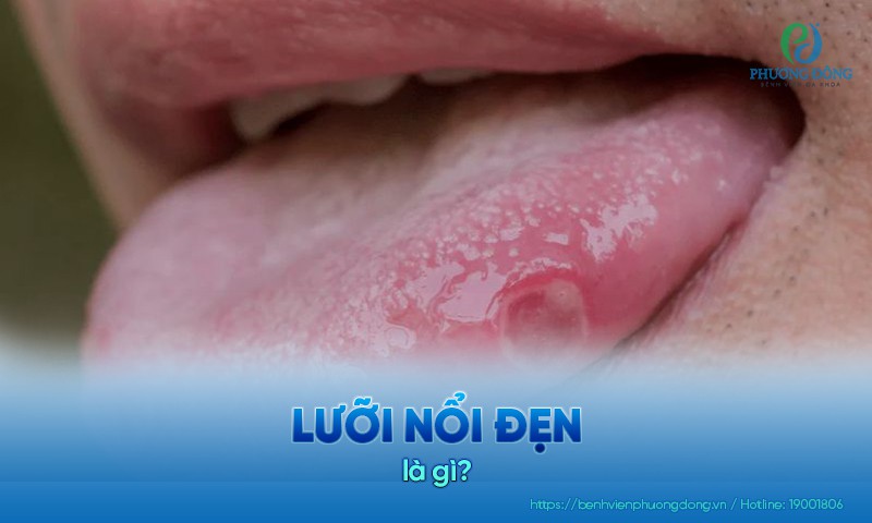 Lưỡi nổi đẹn hình thành do sự xâm nhập của nấm Candida