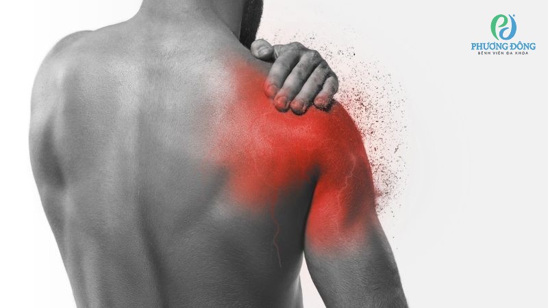 Biểu hiện thường gặp của gai xương bả vai