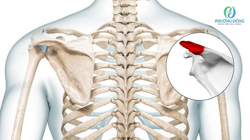 Nguyên nhân hình ảnh mỏm gai xương bả vai