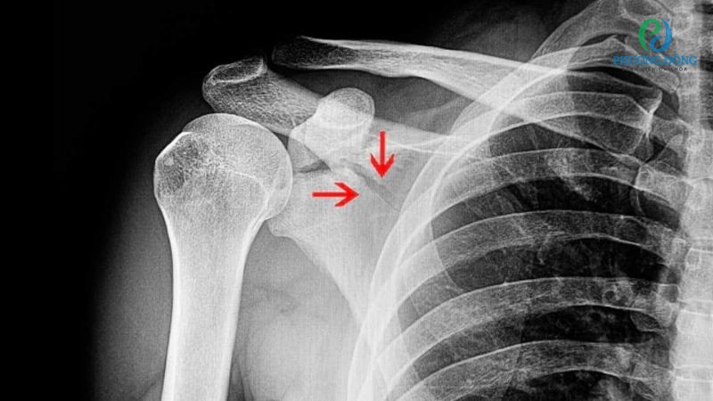 Một số phương pháp chẩn đoán gai xương bả vai