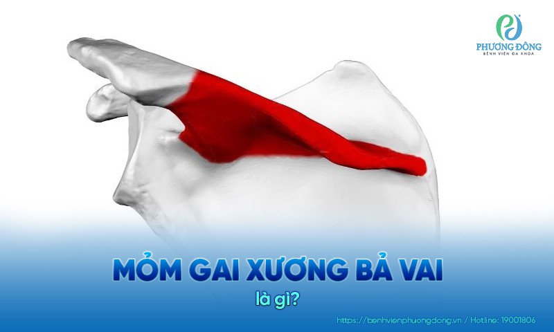 Mỏm gai xương bả vai hình thành bởi sự lắng đọng canxi tại gân xương