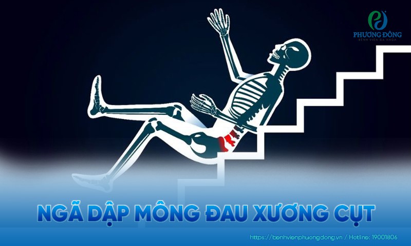 Ngã dập mông đau xương cụt: Dấu hiệu nhận biết và hướng xử trí
