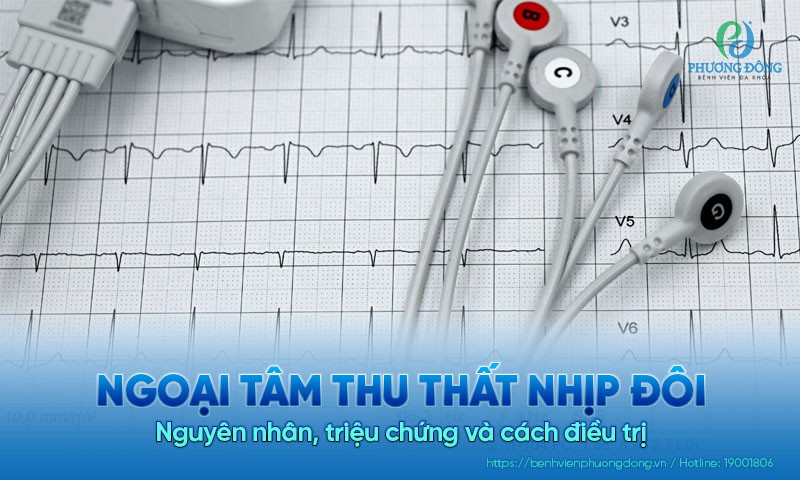 Ngoại tâm thu thất nhịp đôi: Nguyên nhân, triệu chứng và cách điều trị