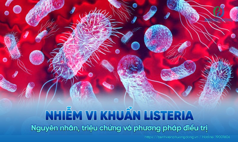 Tổng quan về nhiễm vi khuẩn Listeria: Nguyên nhân, triệu chứng và điều trị