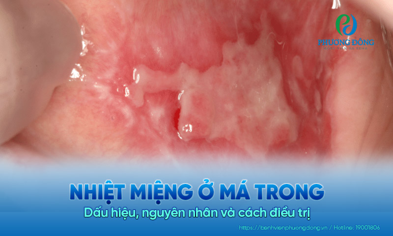 Nhiệt miệng ở má trong: Dấu hiệu, nguyên nhân và cách điều trị