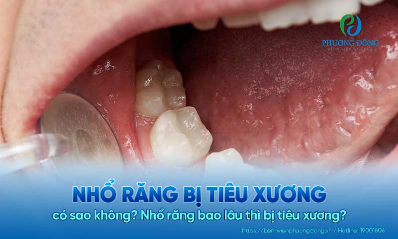 Nhổ răng bị tiêu xương có sao không? Nhổ răng bao lâu thì bị tiêu xương?