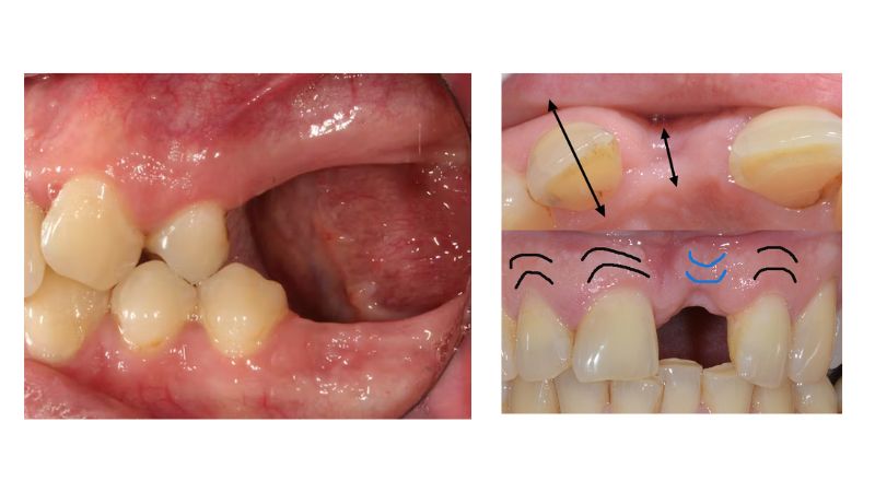 Thời gian mất răng của mỗi bệnh nhân khác nhau
