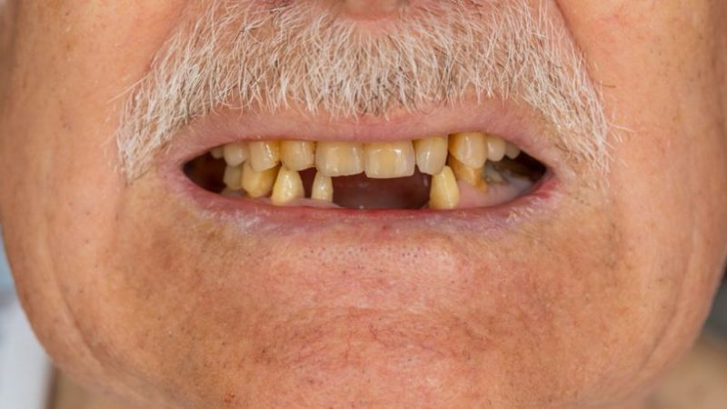 Theo thời gian, các xương xung quanh có thể bị lung lay và mất dần đi
